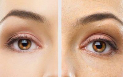 Under the Eye Treatment – Filler and PDO Threads – Q&A