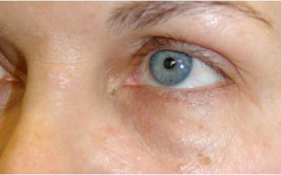 Bellafill Nodule/Lump Treatment Under Eye – Q&A
